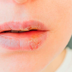 Herpes Labial