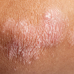 Psoriasis