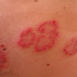 Picor de piel y dermatitis