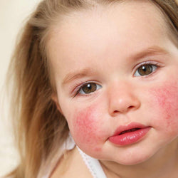 Dermatitis atópica