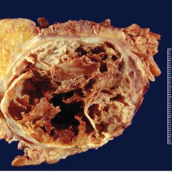 Tumor sólido