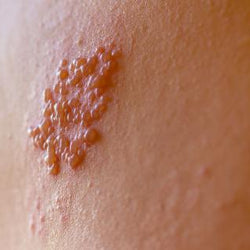 Antivirales