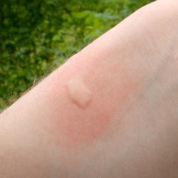 Picadura de mosquitos