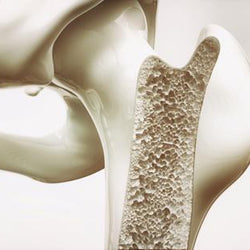 Osteoporosis