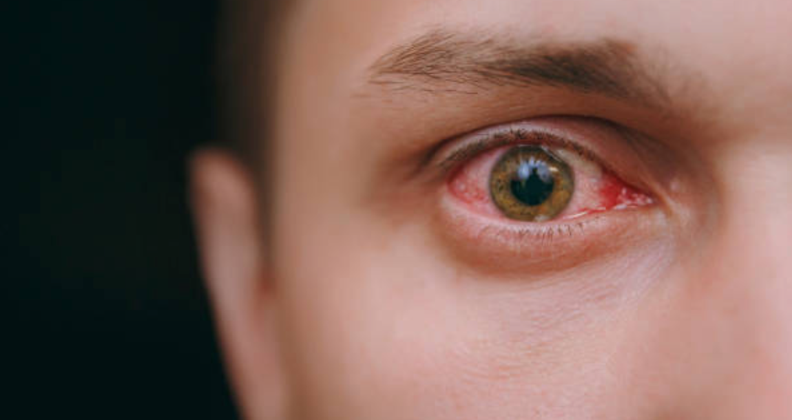Como tratar con productos naturales los ojos rojos