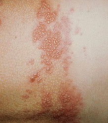 Herpes Zoster