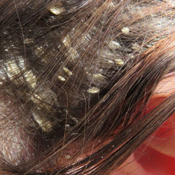 Dermatitis cuero cabelludo