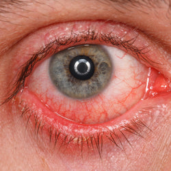 Ojo rojo e irritado