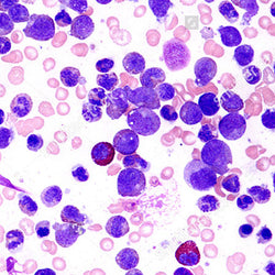 Leucemia linfoide