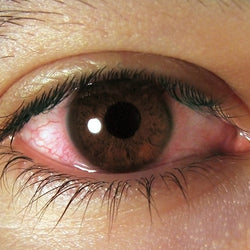 Ojo rojo