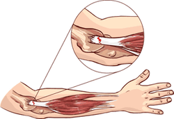 Epicondolitis