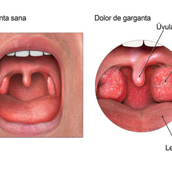 Inflamacion de garganta o faringitis