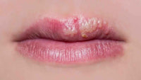 HERPES LABIAL (MEDICAMENTOS)