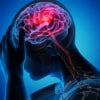 MIGRAÑAS