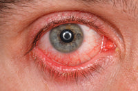 OJO ROJO E IRRITADO