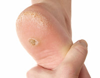 PAPILOMA PLANTAR