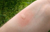 PICADURA DE MOSQUITOS