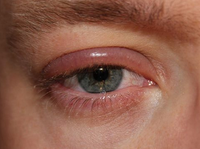 BLEFARITIS