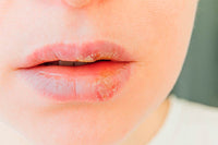 HERPES LABIAL