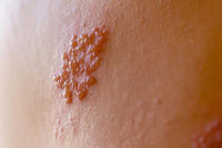 HERPES ZOSTER