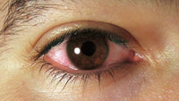 OJO ROJO