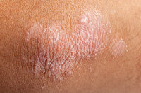 PSORIASIS