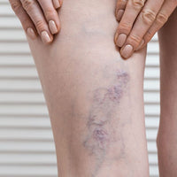 VARICES